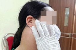 Từ chối xạ trị để dùng thảo dược chữa ung thư, u di căn rộng sau 3 năm