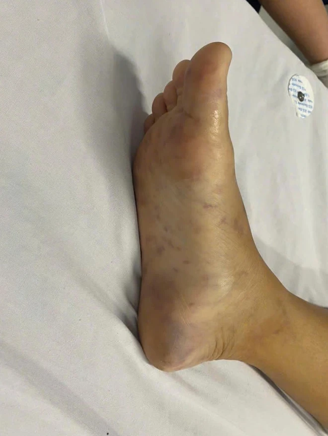 Cơ thể bệnh nhân khi vào viện xuất hiện nhiều ban xuất huyết. Ảnh: BVCC.