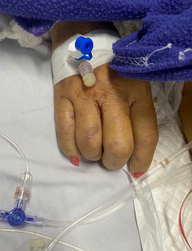 Cơ thể bệnh nhân khi vào viện xuất hiện nhiều ban xuất huyết. Ảnh: BVCC.