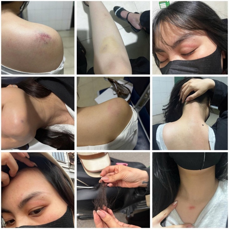 Một số thương tích trên cơ thể chị Ánh sau vụ việc
