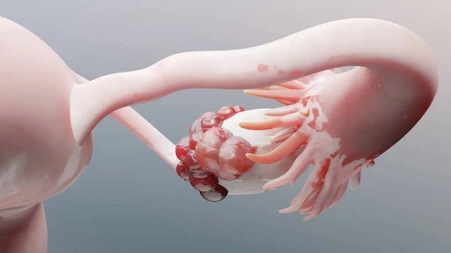 Ung thư buồng trứng là kẻ giết người thầm lặng đối với phụ nữ. Ảnh minh họa.