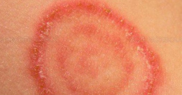 Cảnh giác nấm da lây từ chó, mèo