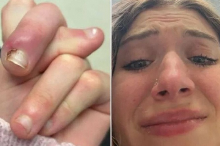 Suýt mất ngón vì thói quen cắn móng tay