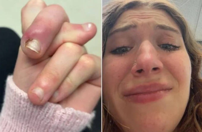 Ngón tay sưng tấy do tích tụ mủ của Swierzewski. Ảnh: Instagram Gabby Swierzewski