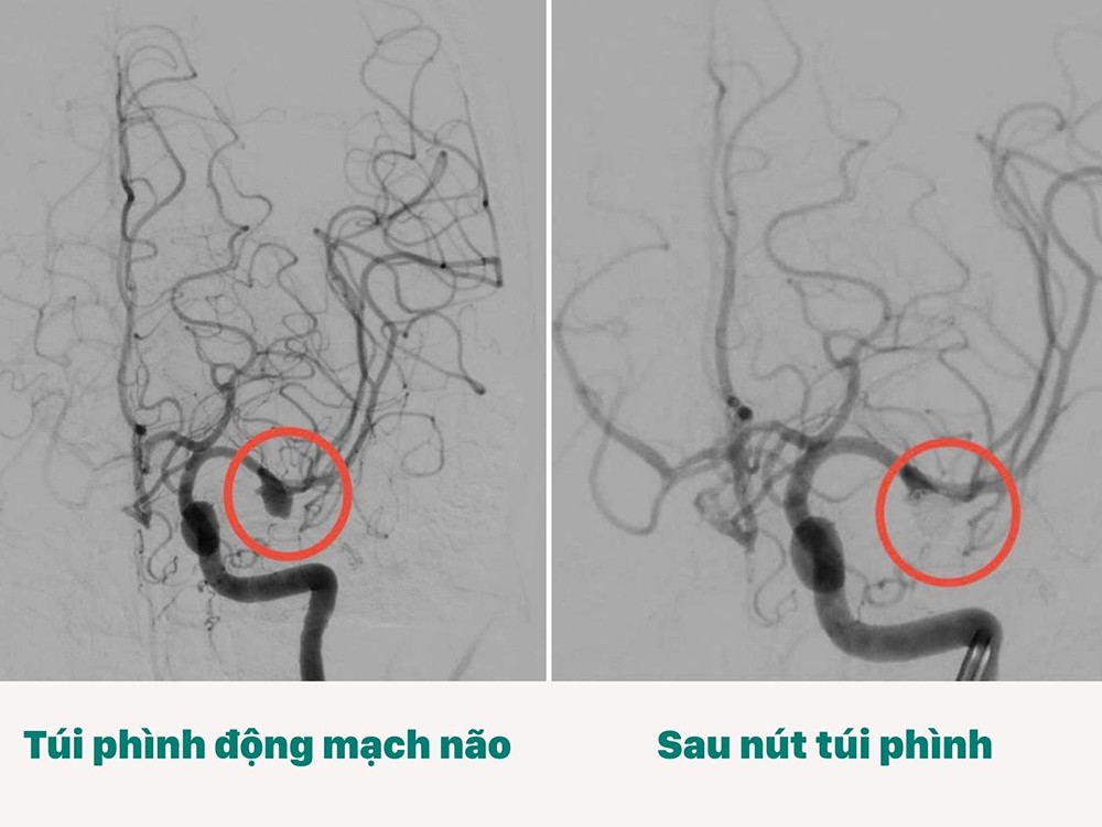 Hình ảnh trước - sau khi can thiệp nút túi phình
