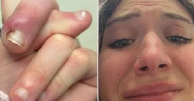 Suýt mất ngón vì thói quen cắn móng tay