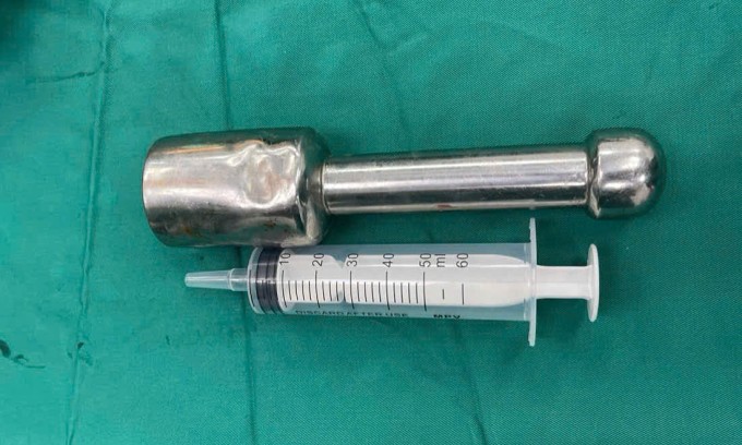 Dị vật sau khi được lấy ra. Ảnh: Bệnh viện cung cấp