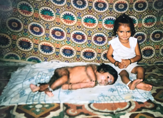 Lalit Patidar mắc chứng rậm toàn thân ngay từ khi sinh ra. Ảnh: Thesun