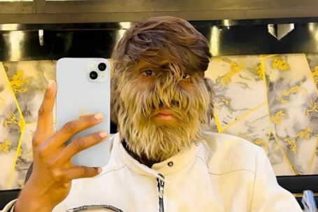 Cuộc sống của thiếu niên có nhiều lông nhất thế giới giờ ra sao?