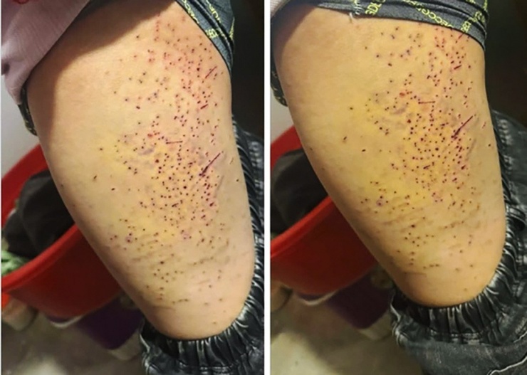 Hình ảnh em học sinh với nhiều vết chấm đỏ trên phần đùi. Ảnh: TD