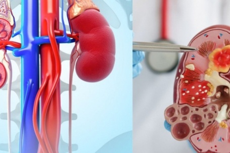 7 loại trái cây quen thuộc người bệnh suy thận nên hạn chế, nhiều người Việt vẫn ăn mỗi ngày