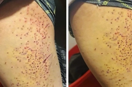 Tranh chấp chỗ ngồi, nữ sinh lớp 7 dùng bút bi đâm nhiều lần vào đùi bạn học