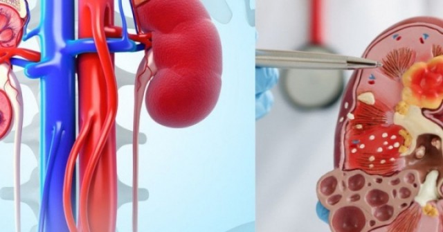 7 loại trái cây quen thuộc người bệnh suy thận nên hạn chế, nhiều người Việt vẫn ăn mỗi ngày