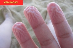 Tin tức sức khỏe - Nhiều người bỏ qua dấu hiệu này, đến khi đau đến mức bật khóc mới phát hiện thoát vị đĩa đệm thì đã muộn