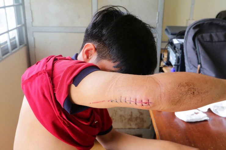 Nạn nhân bị chém thương tích ở cánh tay. Ảnh: Phước Thanh/Công an tỉnh Đồng Tháp.&nbsp;