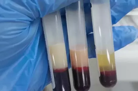 Huyết tương đục như sữa, viêm tụy hoại tử sau chuỗi ngày tiệc tùng