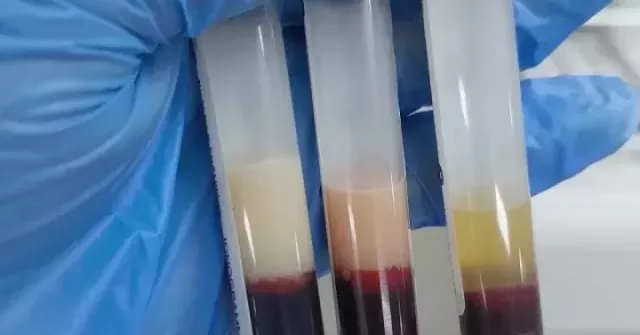 Huyết tương đục như sữa, viêm tụy hoại tử sau chuỗi ngày tiệc tùng