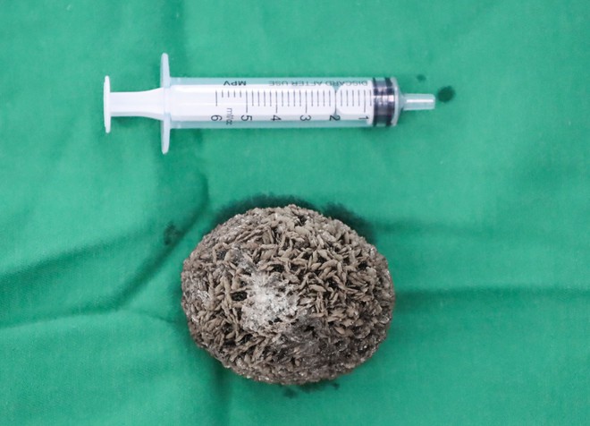 Viên sỏi bàng quang kích thước khoảng 60x40 mm được lấy ra sau phẫu thuật tại Bệnh viện Ngoại khoa 115 Nghệ An.