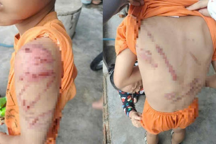 Lý do người cha đánh con 10 tuổi bầm tím khắp người