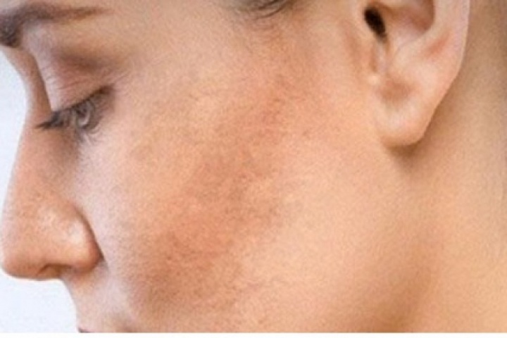 Vì sao da ngày càng sạm màu? Cách lấy lại làn da sáng khỏe