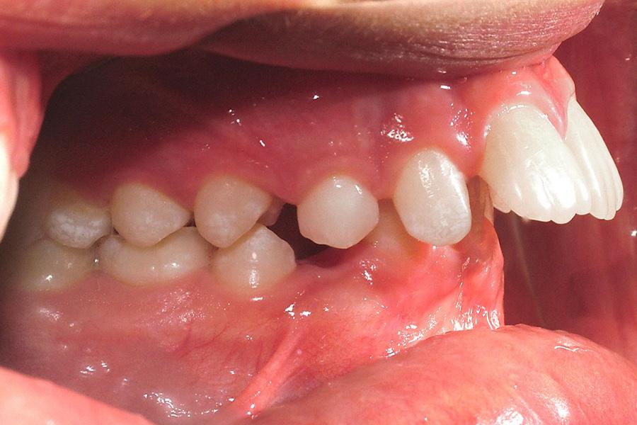 Tình trạng răng hô quá nặng, lệch quá nhiều so với hàm dưới.