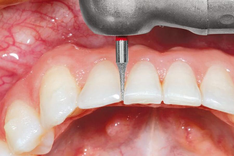 Kỹ thuật mài kẽ răng để tạo khoảng trống cho răng dịch chuyển trong chỉnh nha.