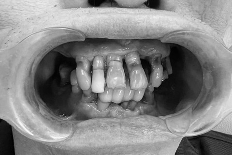 Cận cảnh tình trạng mất răng gây xô lệch các răng còn lại trên cung hàm.