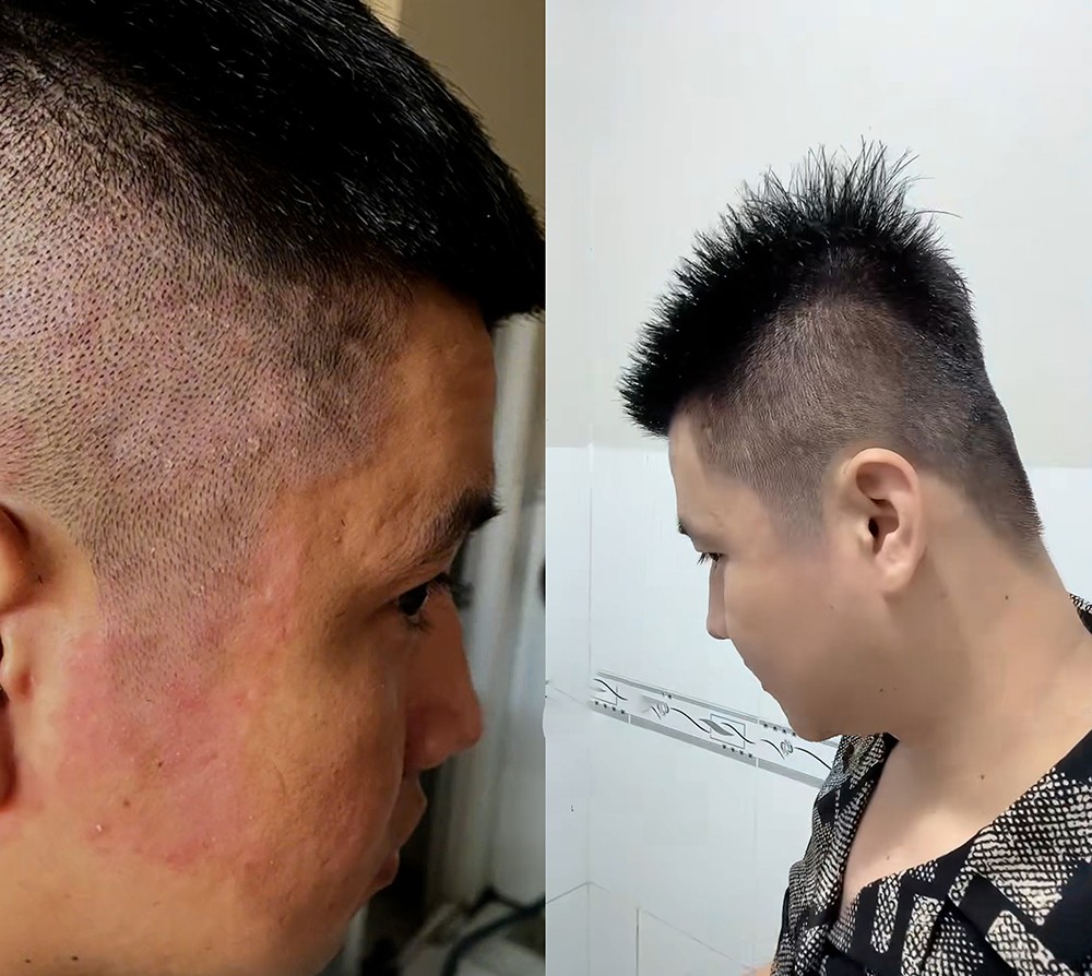 Thời tiết nóng ẩm khiến gàu ngứa tăng sinh