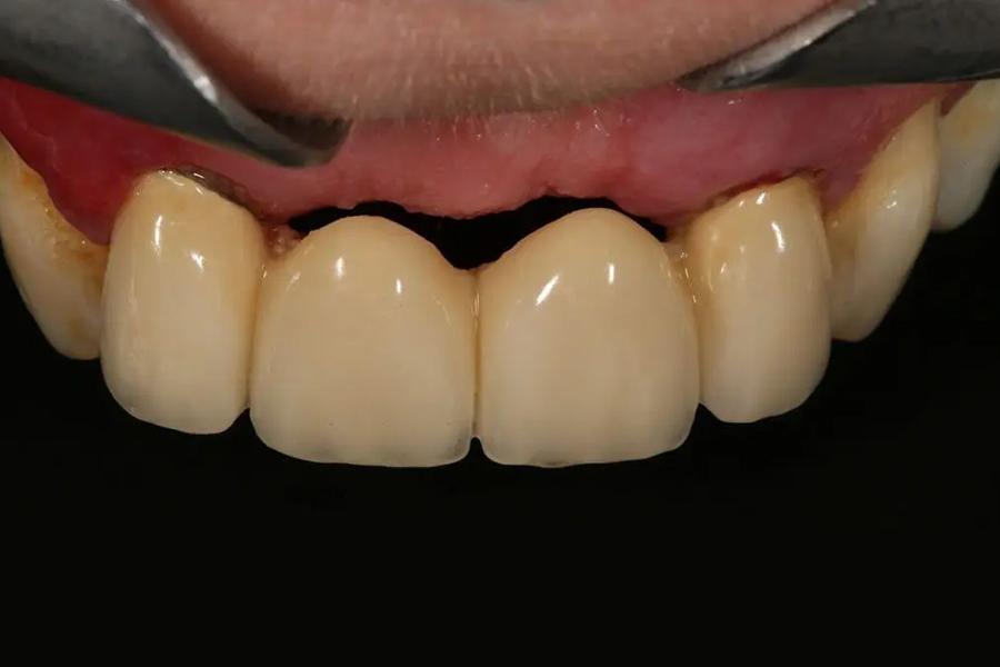 Cầu răng sứ gây ra tình trạng tiêu xương hàm sau thời gian sử dụng.