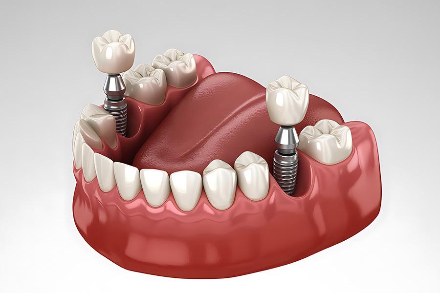 Trụ implant đóng vai trò như một chân răng thật, giúp ngăn tiêu xương hàm và giữ cấu trúc mặt.