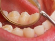 Ngoài thuốc lá, yếu tố nào làm tăng nguy cơ ung thư khoang miệng?