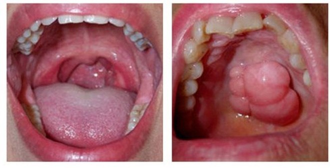 Nếu trong gia đình có người mắc ung thư khoang miệng hoặc các loại ung thư khác, nguy cơ mắc bệnh cũng có thể cao hơn.