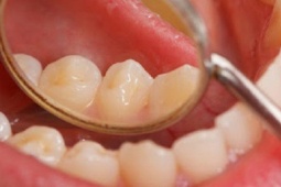 Ngoài thuốc lá, yếu tố nào làm tăng nguy cơ ung thư khoang miệng?