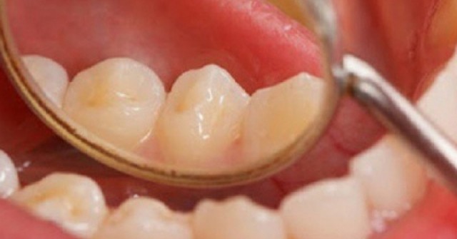 Ngoài thuốc lá, yếu tố nào làm tăng nguy cơ ung thư khoang miệng?