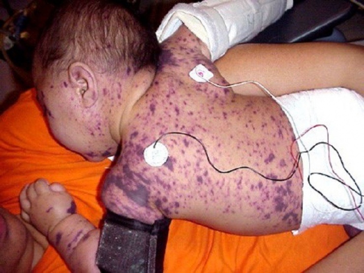 Từ ban bùng phát trên cơ thể bệnh nhi mắc não mô cầu (ảnh minh họa)