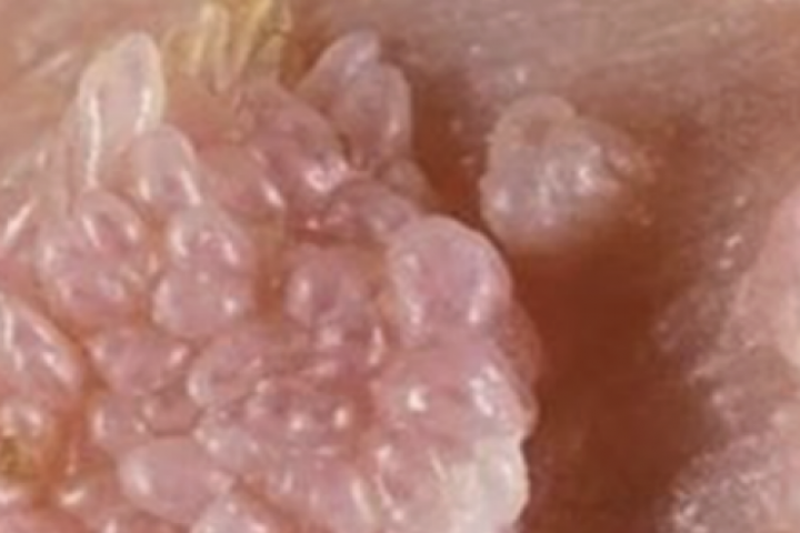 Người đàn ông gần 70 tuổi mắc sùi mào gà sau quan hệ không an toàn