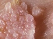 Người đàn ông gần 70 tuổi mắc sùi mào gà sau quan hệ không an toàn