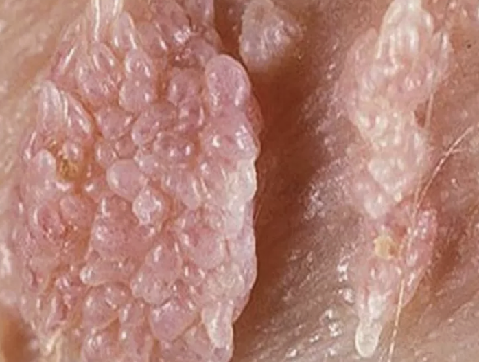 Hình ảnh tổn thương do mắc sùi mào gà. Ảnh minh hoạ