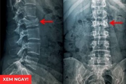 Tin tức sức khỏe - 3 tư thế ngủ tốt nhất giúp giảm đau rõ rệt cho người bị thoái hóa cột sống