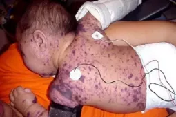 Bác sĩ cảnh báo sau ca tử vong do não mô cầu