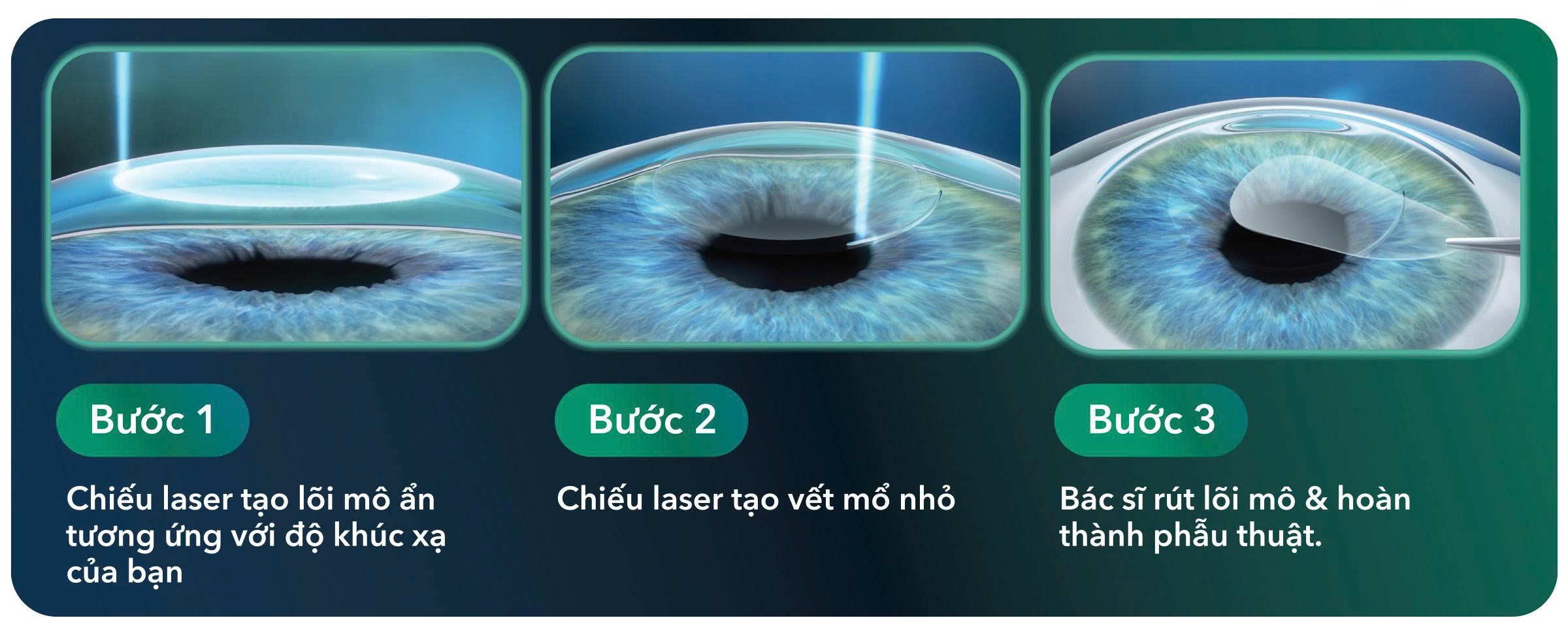Xóa cận vết mổ nhỏ (KLEx – Keratorefractive Lenticule Extraction) khử độ khúc xạ bằng cách rút lõi mô và không tạo vạt giác mạc