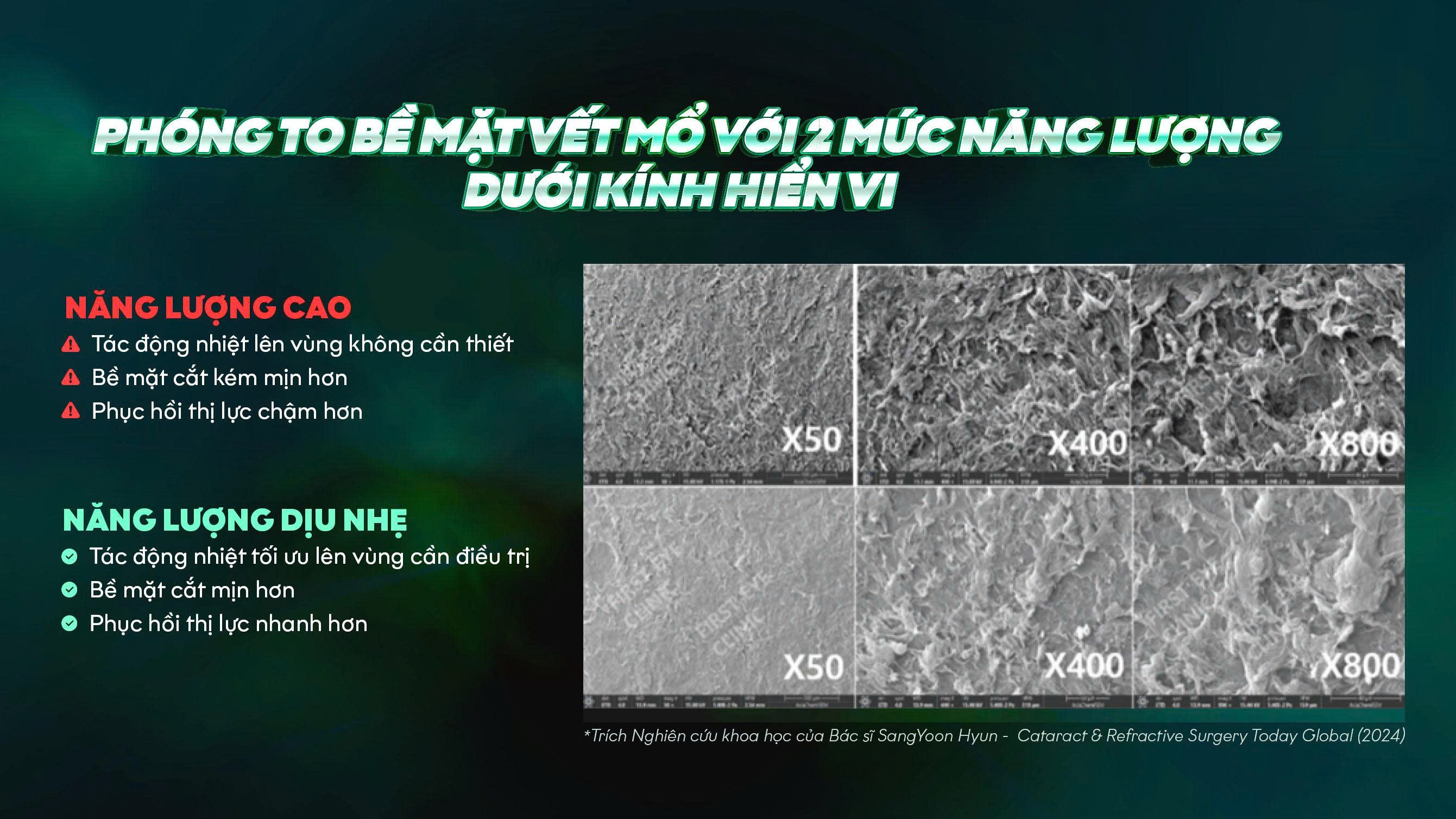 Nghiên cứu của bác sĩ SangYoon Hyun (2024) so sánh bề mặt phẫu thuật xóa cận khi sử dụng 2 mức năng lượng