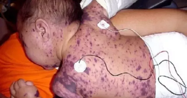 Bác sĩ cảnh báo sau ca tử vong do não mô cầu