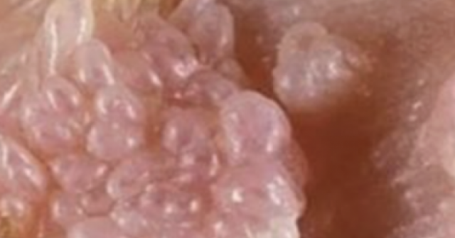 Người đàn ông gần 70 tuổi mắc sùi mào gà sau quan hệ không an toàn