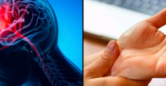 Dấu hiệu nguy hiểm nhất của đột quỵ không phải tê tay chân, nhiều người vẫn đang hiểu lầm