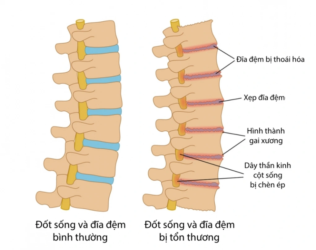 3 tư thế ngủ tốt nhất giúp giảm đau rõ rệt cho người bị thoái hóa cột sống - 5