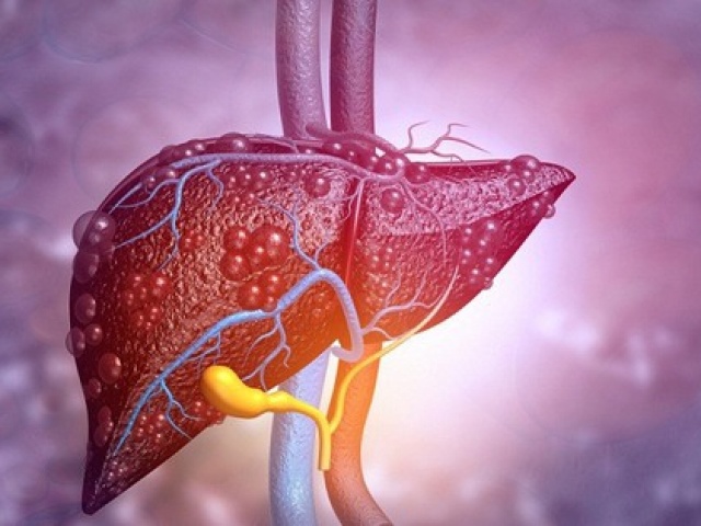 4 giải pháp trị gan nhiễm mỡ không dùng thuốc