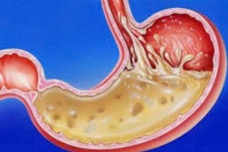 Tin tức sức khỏe - Những nguy hiểm mà người bị trào ngược dạ dày nhất định phải biết nếu không xử lý đúng cách