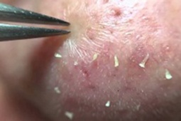 Tin tức sức khỏe - Mụn con trai có cơ chế khác biệt, cần xử lý bằng cách này thay vì bôi kem và đi Spa như con gái