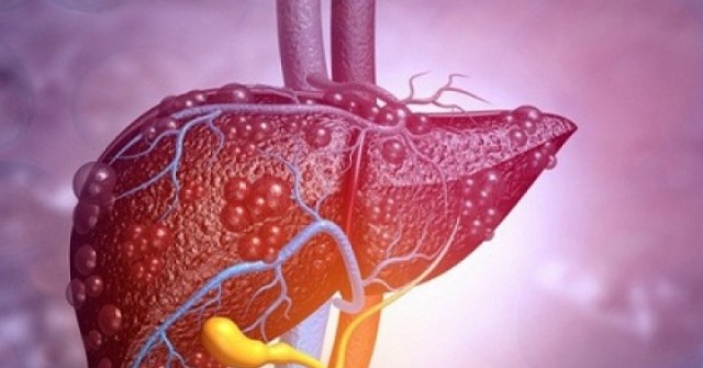 4 giải pháp trị gan nhiễm mỡ không dùng thuốc